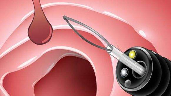 【健康解碼&middot;小貼士】檢查出息肉 需要切除嗎？