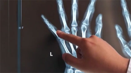 飲食不節制 19歲小伙兒全身遍布&ldquo;痛風石&rdquo;